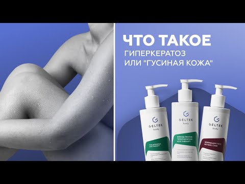 Видео: Что такое гиперкератоз или "гусиная кожа"
