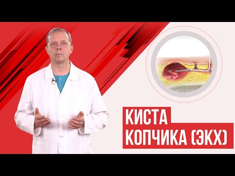 Видео: Киста копчика. Эпителиальный копчиковый ход.