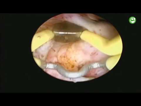 Видео: Биполярная электроэнуклеация гиперплазии простаты