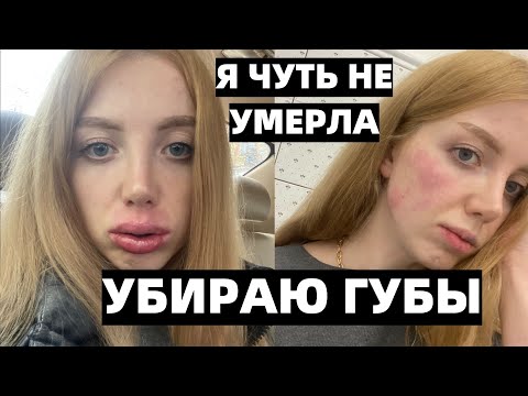 Видео: Я ЧУТЬ НЕ УМЕРЛА У КОСМЕТОЛОГА!!! УБИРАЮ ГУБЫ ПОЛНОСТЬЮ