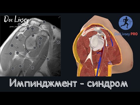 Видео: Импинджмент синдром