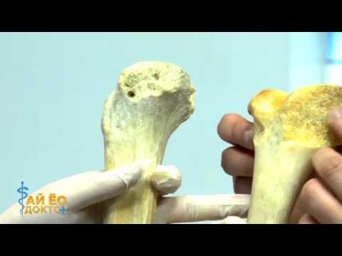 Видео: "Ай ёо доктор" эрүүл мэндийн нэвтрүүлэг - 9. Ясны сийрэгжилт