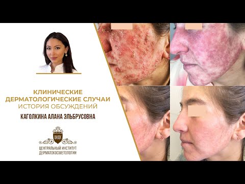 Видео: Тайны дерматологов или как сохранить здоровье кожи: клинические случаи, обсуждение, советы от ЦИДК!