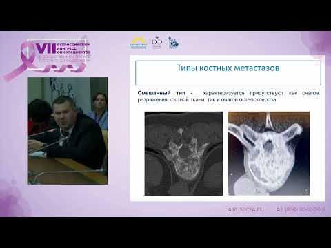 Видео: Борзов К.А. | Метастазы в позвоночник: приговор или диагноз. Современные тенденции лечения
