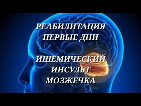 Видео: Ишемический инсульт мозжечка! Реабилитация! Первые дни!