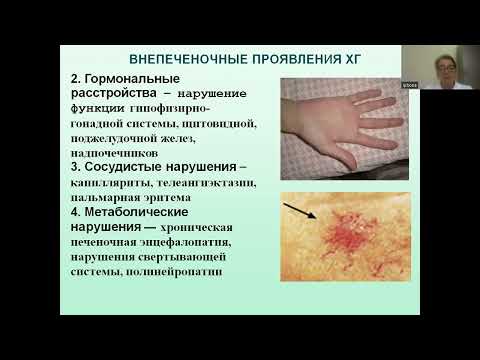 Видео: Хронические гепатиты у детей