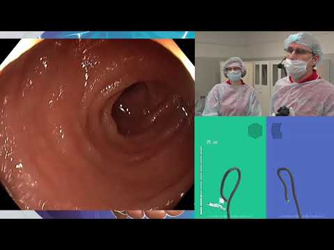 Видео: Эндоскопическая резекция аденомы толстой кишки с применением лигирующей петли Endoloop. С. В. Кашин