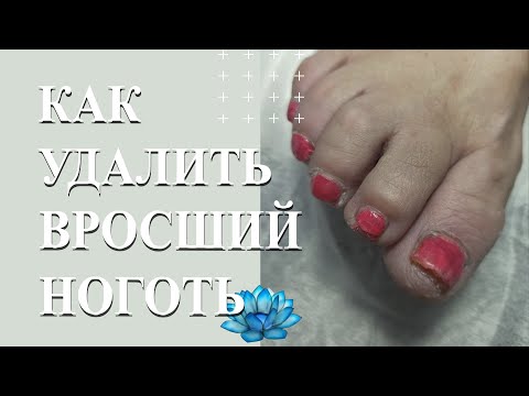 Видео: Вросший ноготь на большом пальце ноги. Удаление вросшего ногтя.