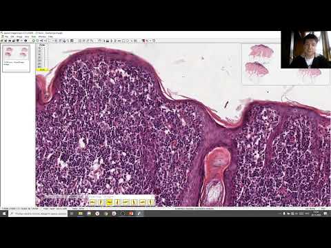 Видео: Гало невус