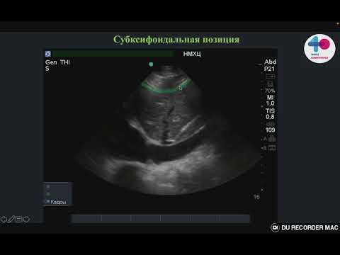 Видео: HOW TO   Мониторинг волемического статуса, нижняя полая вена