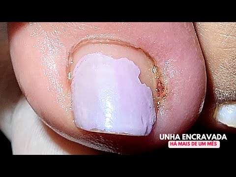 Видео: 😱 ТАК ВРОС НОГОТЬ БОЛЬШЕ МЕСЯЦА (с субтитрами)