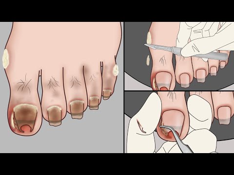 Видео: ASMR Анимация удаления вросшего ногтя на ноге~Удовлетворение!  | Meng's Stop Motion