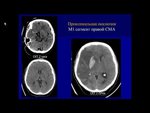 Видео: Костеников А.Н.«Неотложная КТ, МРТ, ЦАГ ишемического инсульта в условиях сосудистого центра»