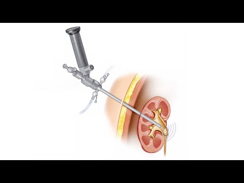 Видео: Удаление камней через прокол: что нужно знать про перкутанную литотрипсию