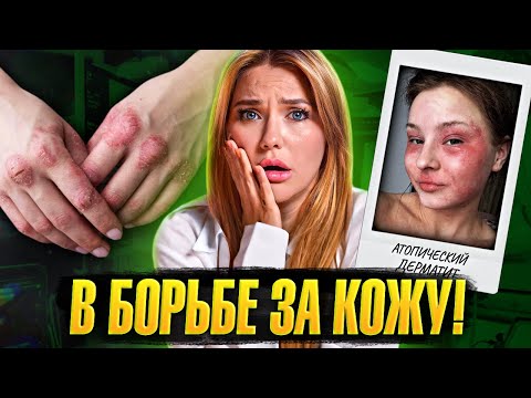 Видео: КАК С ЭТИМ ЖИТЬ? | Зависимость от гормонов | атопический дерматит