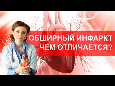 Видео: Обширный инфаркт. Чем отличается от обычного инфаркта?