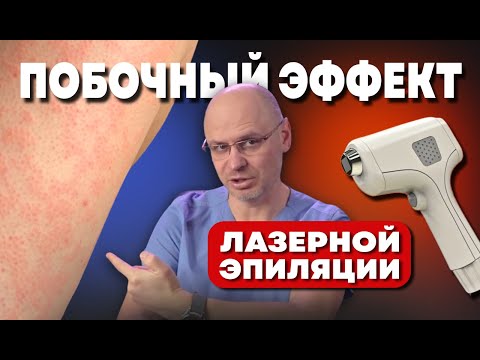 Видео: ПОБОЧНЫЙ ЭФФЕКТ ЛАЗЕРНОЙ ЭПИЛЯЦИИ | ОСЛОЖНЕНИЕ ЛАЗЕРНОЙ ЭПИЛЯЦИИ