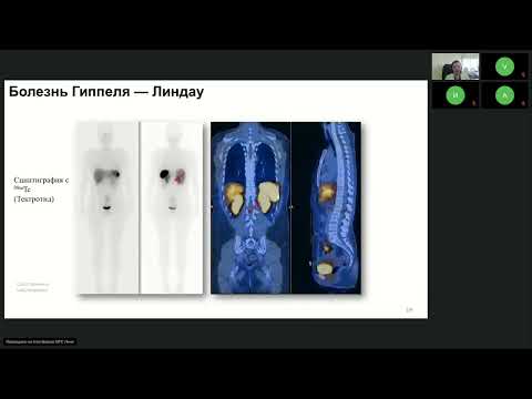 Видео: Нейроэндокринные опухоли (вебинар 25 марта 2024)