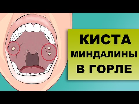 Видео: КИСТА МИНДАЛИНЫ В ГОРЛЕ. Причины и лечение