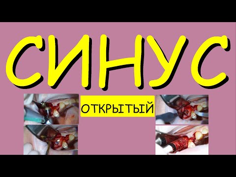Видео: СИНУС. ОТКРЫТЫЙ.