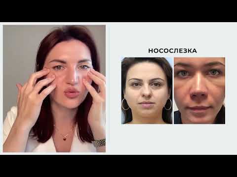 Видео: ⚠️ Как убрать носослёзную борозду массажем?