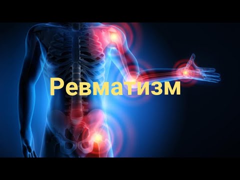 Видео: РЕВМАТИЗМ / МУЗДАК ТАМАНДАР