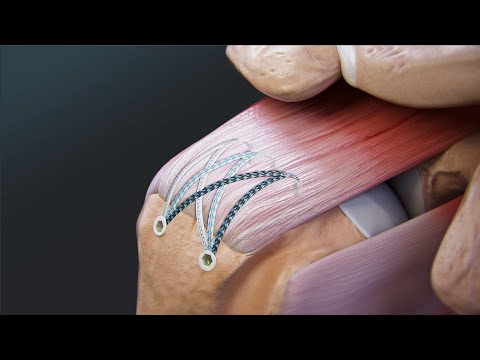 Видео: Восстановление вращательной манжеты плеча FiberTak® SpeedBridge™