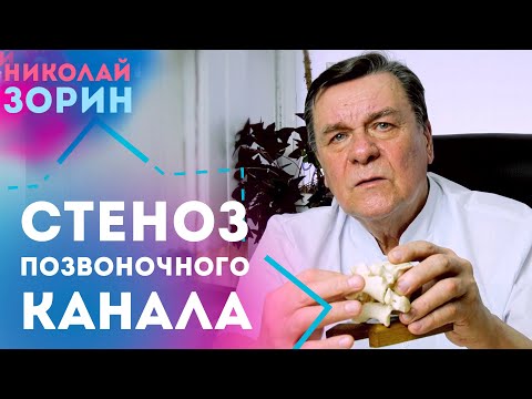 Видео: Стеноз позвоночного канала