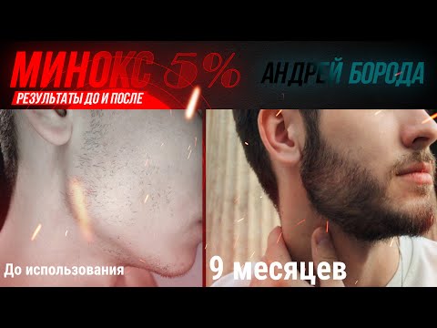 Видео: Миноксидил результаты До и После. Андрей Борода Выпуск №21 Как запустить рост бороды