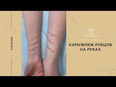 Видео: Камуфляж рубцов на руке