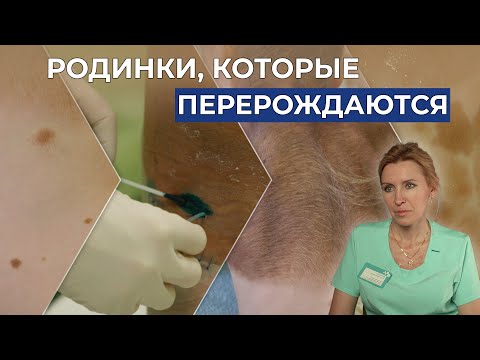 Видео: МЕЛАНОФОРМНЫЙ НЕВУС | История Андрея Сухорукова