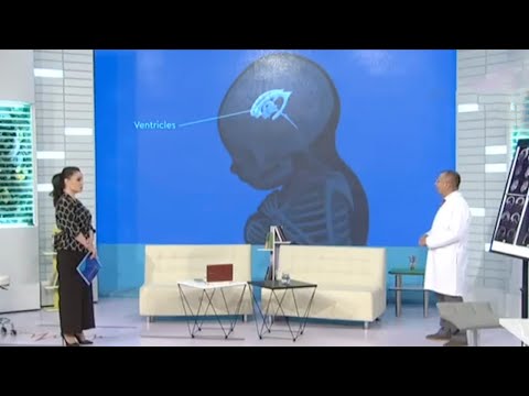 Видео: Гидроцефалия(бош мияда ортиқча сувнинг тўпланиши) касаллиги | Salomatlik formulasi