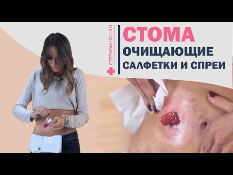 Видео: Как правильно очистить кожу вокруг стомы?  | Стерильно.com