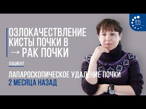 Видео: Озлокачествление кисты почки в рак почки. Лапароскопическое удаление почки 2 месяца назад