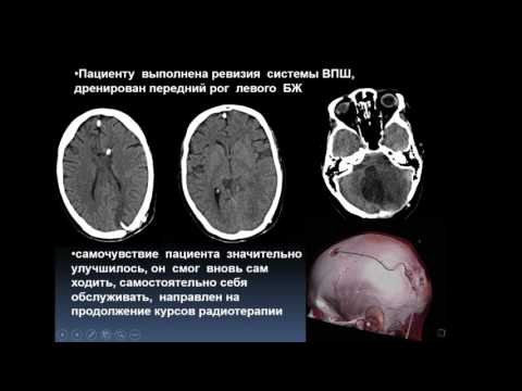 Видео: Клиническое наблюдение. Случай тяжелого лечения болезни Гиппеля-Линдау у молодого пациента