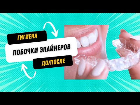 Видео: Что может произойти с зубами при лечении на элайнерах. Кейс до/после 