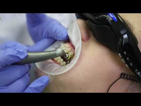 Видео: Как проводят профессиональную чистку зубов с брекетами