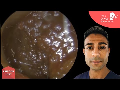 Видео: 1287 - Двустороннее полное удаление ушной серы