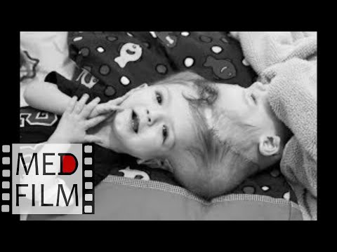 Видео: (2) Сиамские близнецы, академик К.В.Судако́в  © (2) Siamese twins