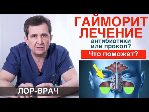 Видео: ЛЕЧЕНИЕ ОСТРОГО гайморита. Прокол или антибиотики?