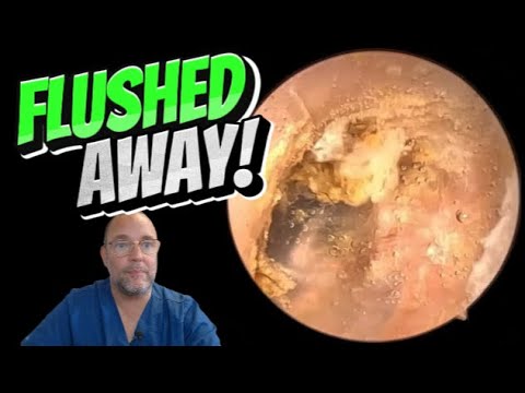 Видео: СМЫТО! 353 #ухо #ушнаясера #удалениеушнойсеры #асмр #удовлетворение #длявас #fyp #foryourpage