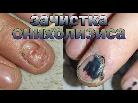Видео: 😣зачистка травматического онихолизиса