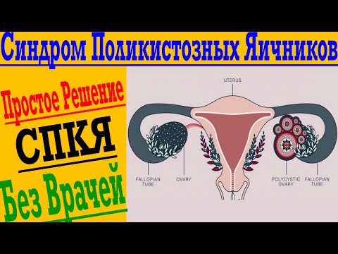 Видео: Синдром Поликистозных Яичников - СПКЯ - PCOS ! Простое решение без врачей и больниц !