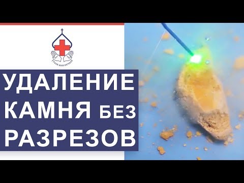 Видео: 💎 Как лечить мочекаменную болезнь. Лечение мочекаменной болезни. 12+