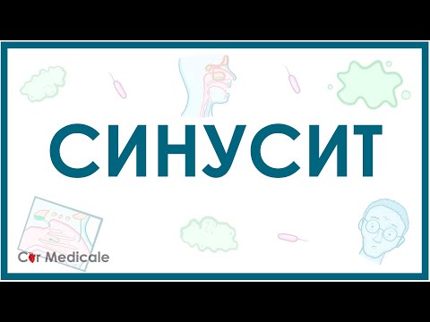 Видео: Синусит: механизм развития, симптомы, диагностика, лечение - кратко