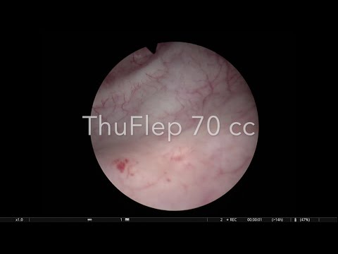 Видео: ThuFlep 70 cc. Лазерная энуклеация гиперплазии простаты / laser enucleation BPH