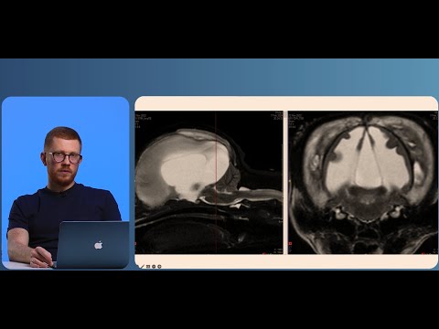 Видео: Чем опасна быстрая коррекция гипонатриемии.
