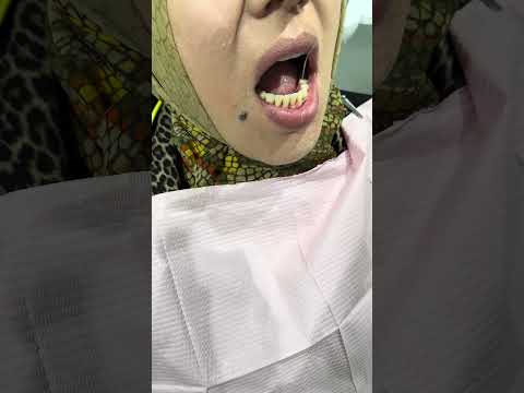 Видео: Вакумли протез. Vakumli protez . Манзил Наманган шахри 4 микрорайон 7 уй. Тел:+998911777720