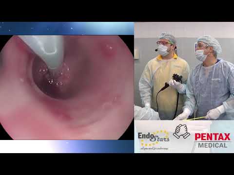 Видео: Эндоскопическое стегтирование опухолевого стеноза пищевода. C. В. Кашин, Д. В. Гусев, В. И. Гончаров