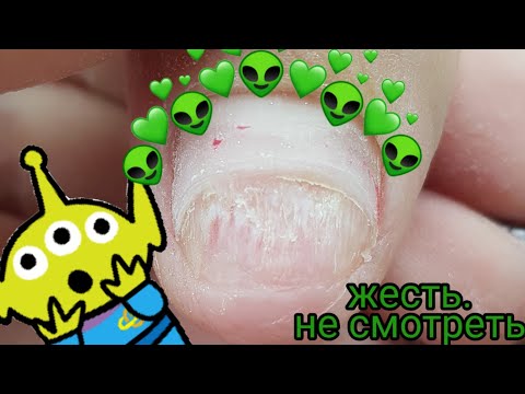 Видео: Онихолизис - часть 4, продолжаем приростать/Лечим травмированный ноготок/Шулунова Дарья